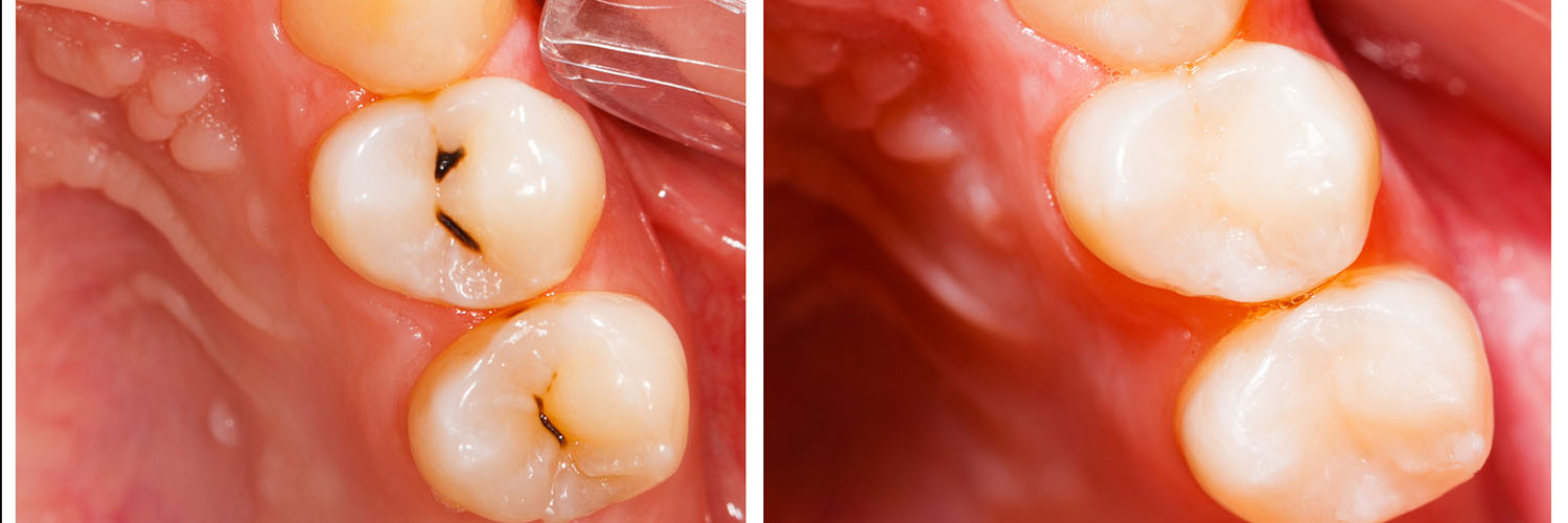 The image shows a close-up view of a person s mouth with visible teeth and gums, emphasizing dental health and hygiene.
