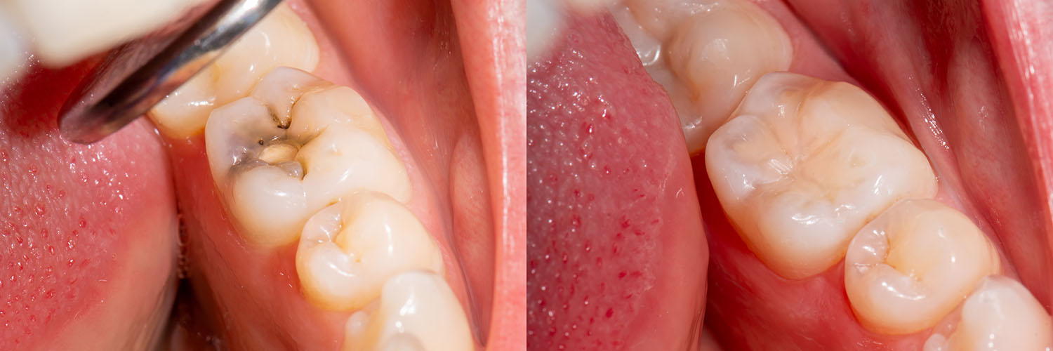 The image shows a close-up of a person s teeth with visible decay and cavities, emphasizing oral hygiene concerns.