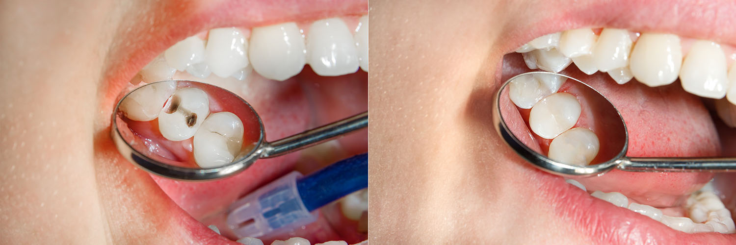 The image shows a close-up of a person s teeth with a dental mirror held up to them, revealing their mouth and teeth.