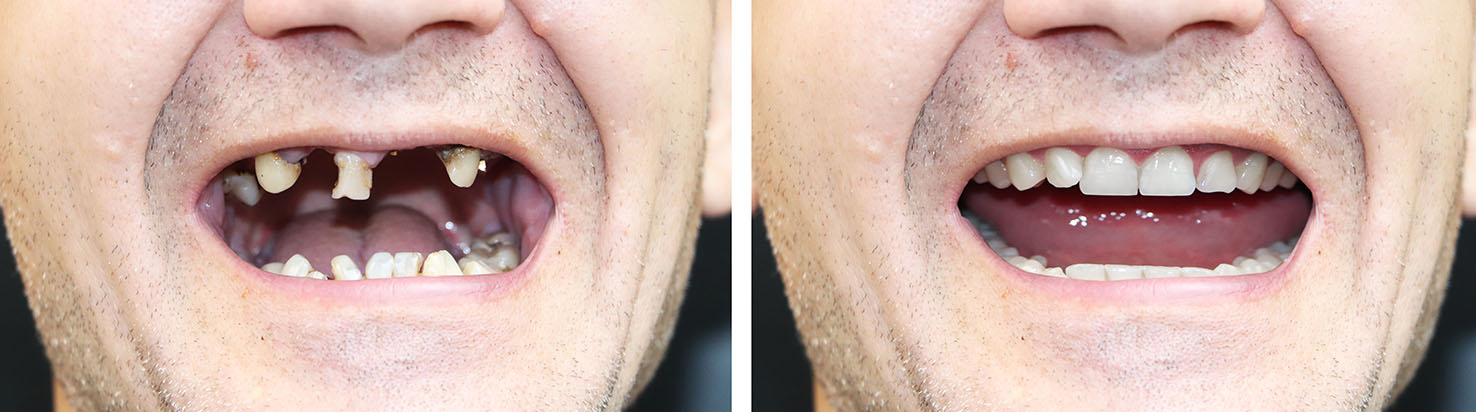 The image shows a collage of three photos featuring an elderly man with toothless gums, each capturing a different facial expression and angle of his mouth.